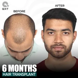 Know the best fue hair transplant cost at qht clinic