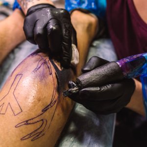 Tattoo removal in delhi – safe, effective & scar-free