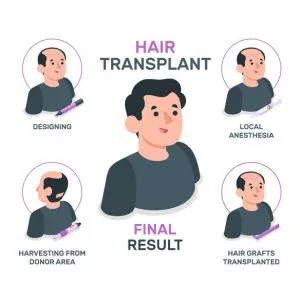 Hair transplant in india – qht clinic