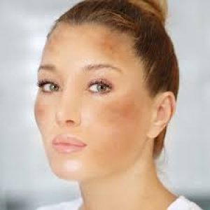 Best melasma treatment in thane – trusted solutions at dna royal