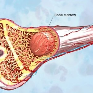 Bone Marrow Transplant Cost in India 