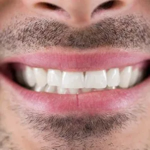 Teeth whitening in virar/ pravin dental