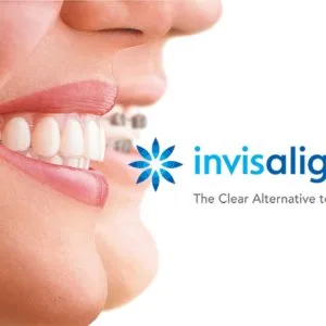 Invisalign center hyderabad – invisible braces experts