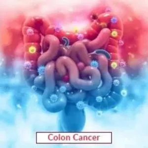 Colon cancer treatment