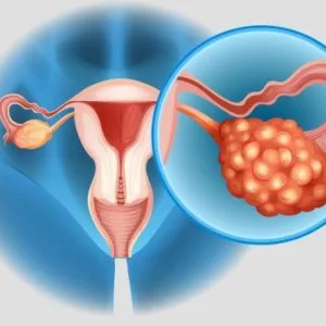 Effective pcod treatment in india: methods, clinics & costs