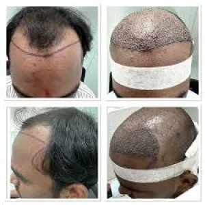 Fue hair transplantation in kondapur