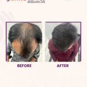 Hair transplantation clinic in hitech city