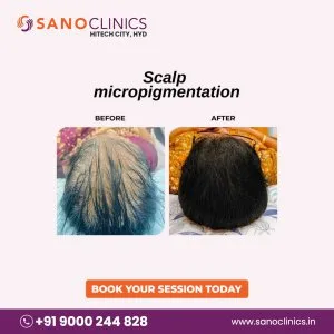 Best hair transplantation in kondapur