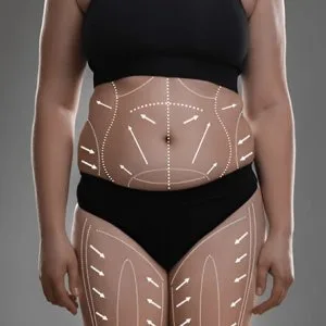 Can you get a brazilian butt lift with a tummy tuck?