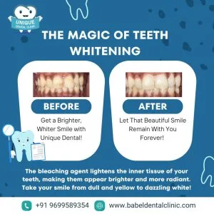 Expert dental cleaning & polishing in pimple saudagar