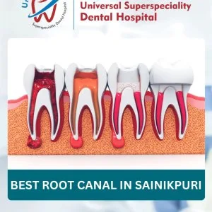 Top reasons to choose a root canal specialist over a general den