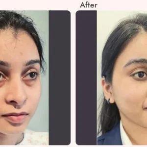 What is single eyelid or double eyelid surgery?
