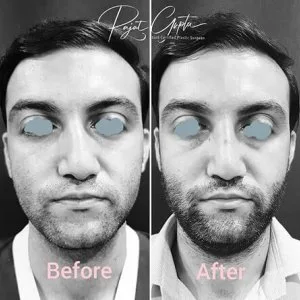 What are rhinoplasty grafts and why are they important?