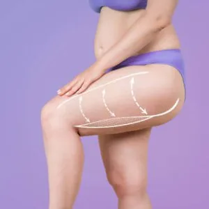 What is a thigh lift surgery?