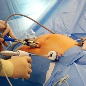 Laparoscopy training in india at world laparoscopy hospital