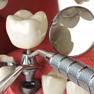 Dental implants in bangalore