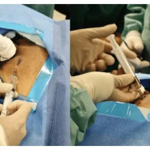 Affordable varicocele surgery cost in pune with expert care