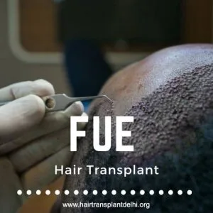 All you need to know about fue hair transplant | hair transplant