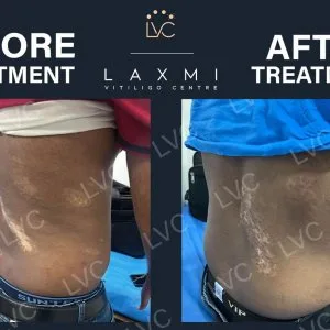 Side effect-free vitiligo treatment – laxmi vitiligo centre