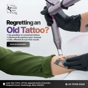 Tattoo removal in darbhanga | clear skin with laser skin clinic