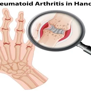 Natural rheumatoid arthritis treatment at nimba
