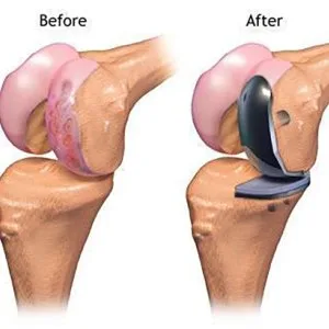 Partial knee replacement surgery in punjab | elite orthopaedics