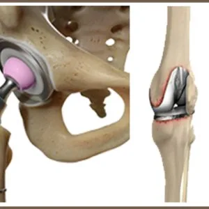 Revision knee & hip replacement surgery | elite ortho india
