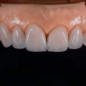 Emax porcelain crowns supplier for dental labs