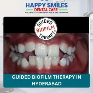 Affordable guided biofilm therapy cost in hyderabad
