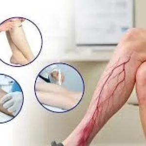 Effective and painless varicose vein treatment in pune