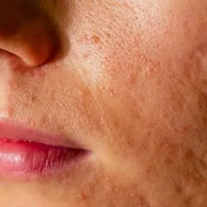 Open pores treatment