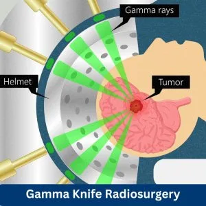 Best gamma knife radiosurgeons of india