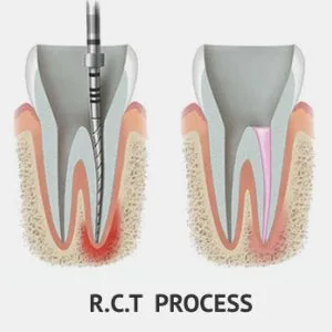 Save your tooth – advanced root canal treatment in noida
