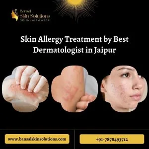 Skin allergy treatment by best dermatologist in jaipur