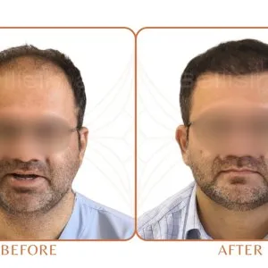 Best hair transplant in ahmedabad | bellisima hair transplant cl