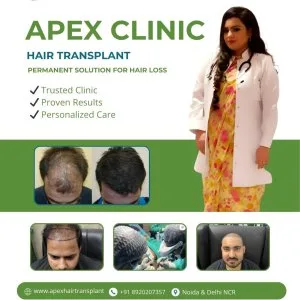 Hair transplant treatment – natural & permanent results