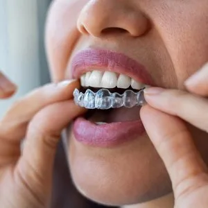 Advanced oral & dental treatment in alwarpet, chennai