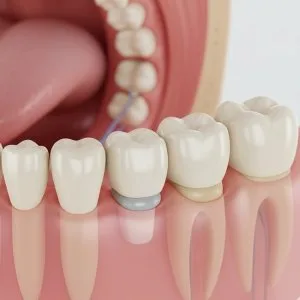 Best dental crowns & bridges treatment in alwarpet