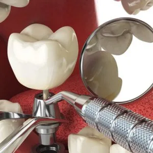 Affordable root canal treatment cost in delhi with expert care