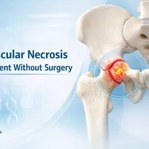 Avascular necrosis treatment without surgery