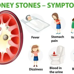 When to see a kidney stone specialist doctor for timely care