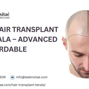 Best hair transplant in kerala advanced affordable
