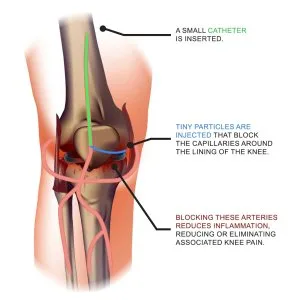 Genicular artery role in knee blood supply and modern treatment