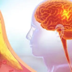 Carotid artery stenosis causes risks and treatment options