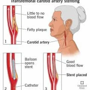 Benefits of carotid artery stenting in india