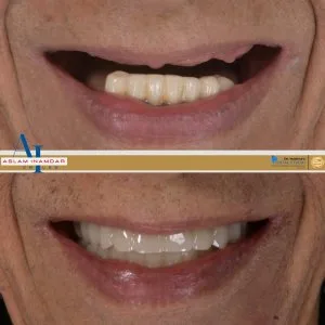 Scared of pain dental implants are easier than you think