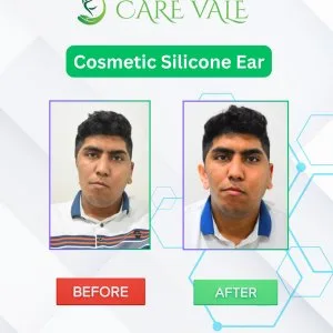 Best artificial leg in hyderabad carevale prosthetics