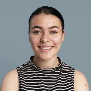 Clear skin starts with the right acne treatment