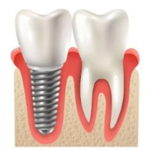 Dental implant treatment in silchar advanced care by dento der