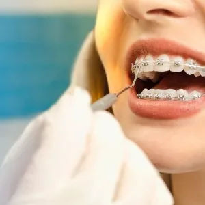 Teeth braces near me braces treatment in pune dr sonali